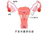 反流性食管炎癥狀(反流性食管炎癥狀有哪些反應(yīng))