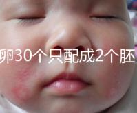 取卵30個(gè)只配成2個(gè)胚胎別放棄！卵巢傷口小移植成功率不低