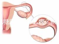 楓糖尿病是什么?。啃律鷥哼@5個指標偏低要注意了