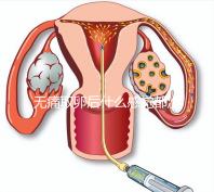 無(wú)痛取卵后什么感覺(jué)都沒(méi)有異常是謠言!只會(huì)出現(xiàn)一部分...