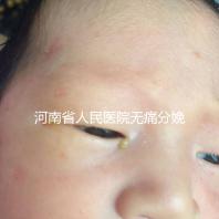 河南省人民醫院無痛分娩多少錢戳，收費標準60s看懂不踩坑