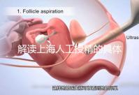 解讀上海人工授精的具體過程，會不會痛看醫(yī)生怎么說？